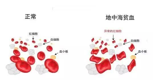 地中海贫血者买哪个险种好?还能买到重疾险吗?插图 地中海贫血者买哪个险种好?还能买到重疾险吗?插图